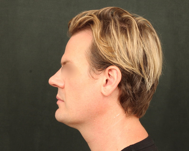 Neck Lift<br><small>(Holiday Neck Lift<sup>TM</sup></small>) Before & After Image