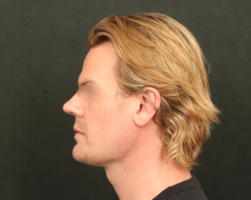 Neck Lift<br><small>(Holiday Neck Lift<sup>TM</sup></small>) Before & After Image