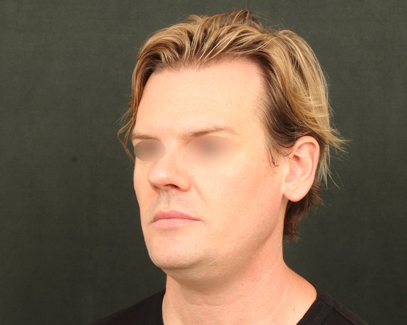 Neck Lift<br><small>(Holiday Neck Lift<sup>TM</sup></small>) Before & After Image