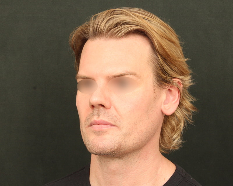Neck Lift<br><small>(Holiday Neck Lift<sup>TM</sup></small>) Before & After Image