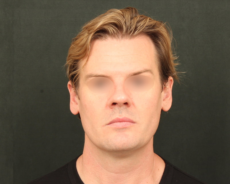 Neck Lift<br><small>(Holiday Neck Lift<sup>TM</sup></small>) Before & After Image