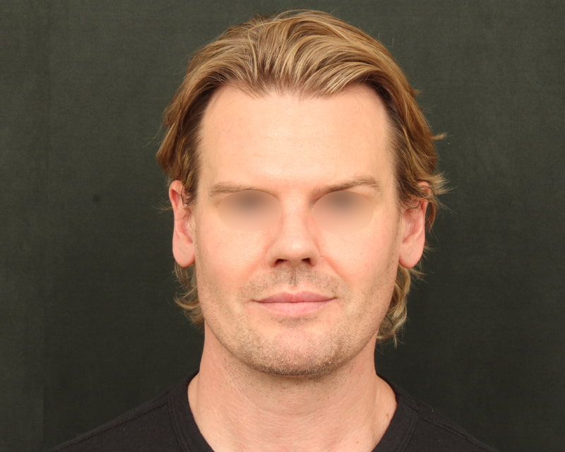 Neck Lift<br><small>(Holiday Neck Lift<sup>TM</sup></small>) Before & After Image