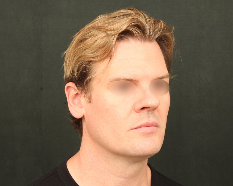 Neck Lift<br><small>(Holiday Neck Lift<sup>TM</sup></small>) Before & After Image