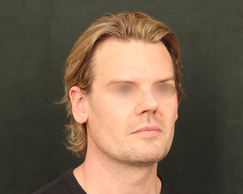Neck Lift<br><small>(Holiday Neck Lift<sup>TM</sup></small>) Before & After Image