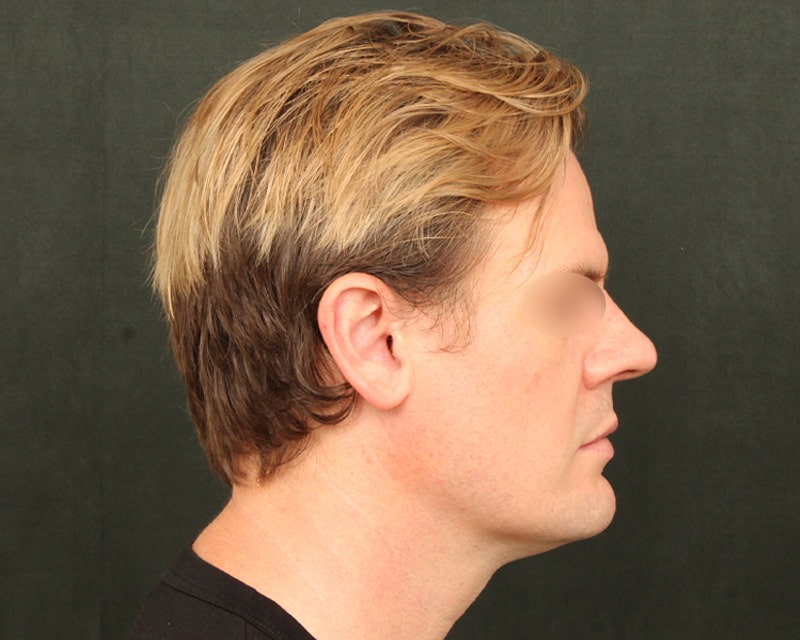 Neck Lift<br><small>(Holiday Neck Lift<sup>TM</sup></small>) Before & After Image