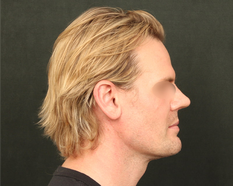Neck Lift<br><small>(Holiday Neck Lift<sup>TM</sup></small>) Before & After Image