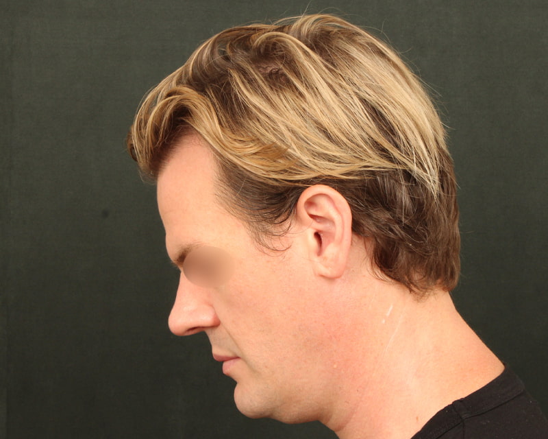 Neck Lift<br><small>(Holiday Neck Lift<sup>TM</sup></small>) Before & After Image