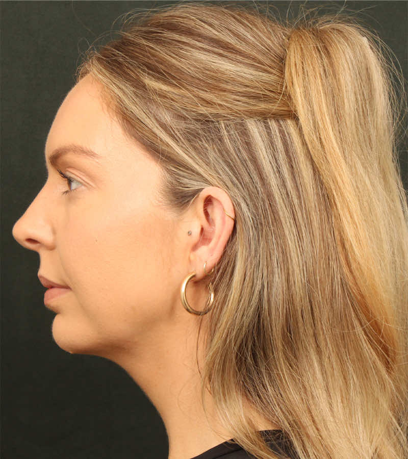 Neck Lift (Holiday Neck Lift) Before & After Image