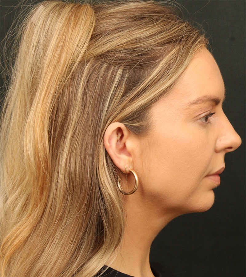 Neck Lift (Holiday Neck Lift) Before & After Image