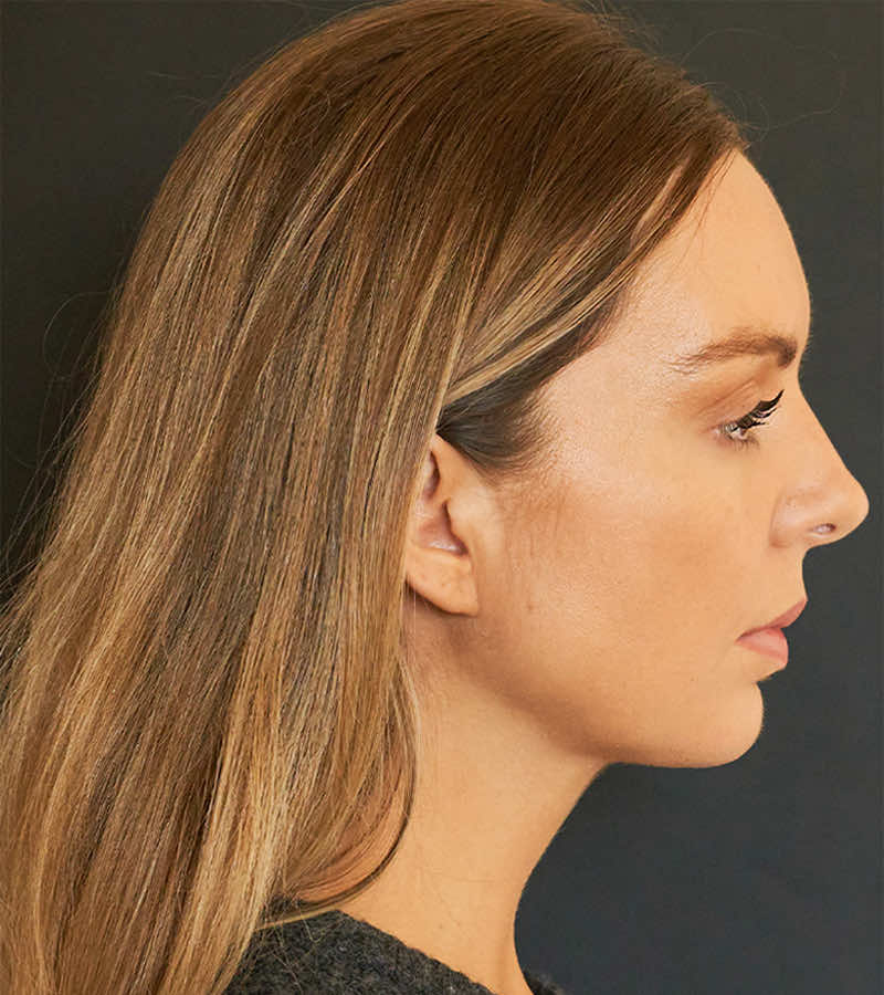 Neck Lift (Holiday Neck Lift) Before & After Image