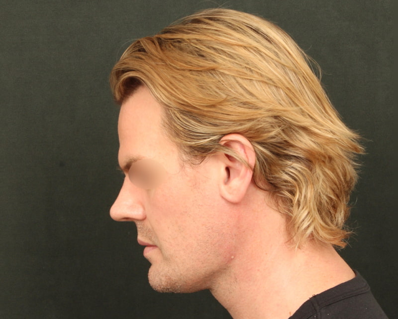 Neck Lift (Holiday Neck Lift™) Before & After Image