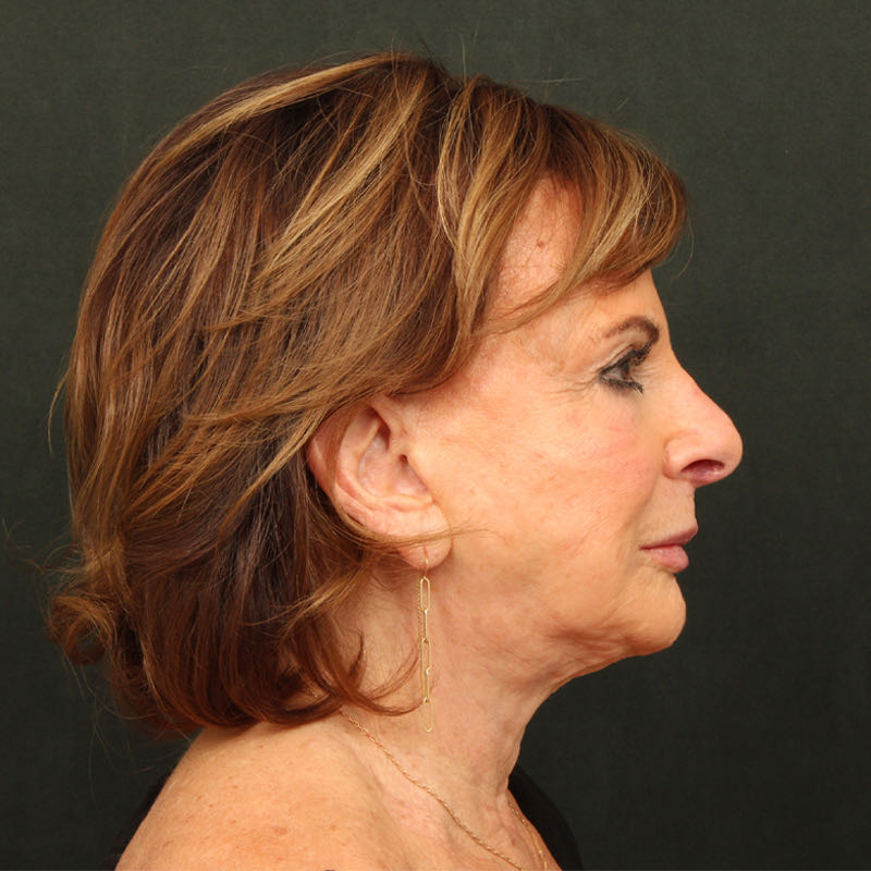 Neck Lift (Holiday Neck Lift) Before & After Image