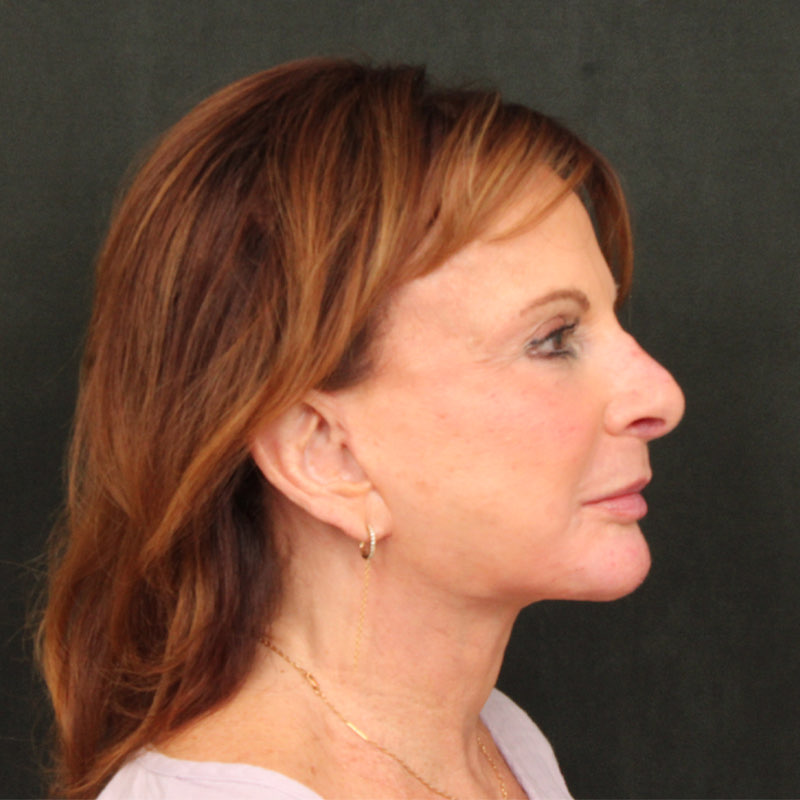 Neck Lift (Holiday Neck Lift) Before & After Image