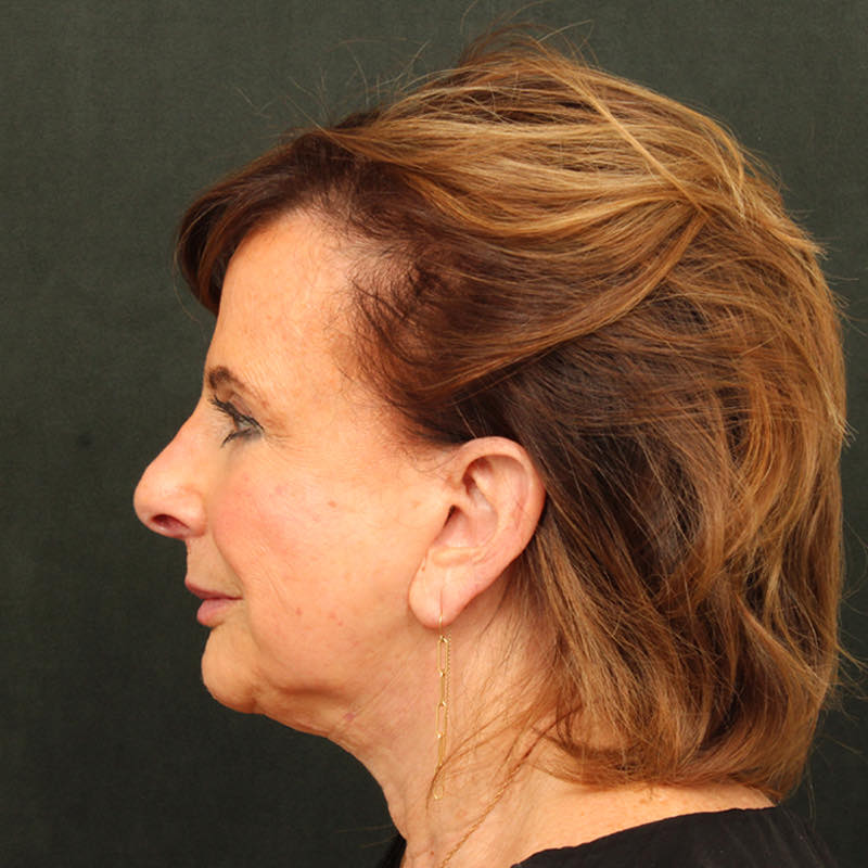 Neck Lift (Holiday Neck Lift) Before & After Image