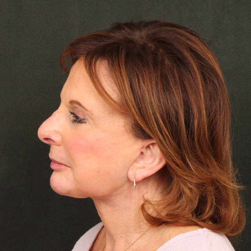 Neck Lift (Holiday Neck Lift) Before & After Image