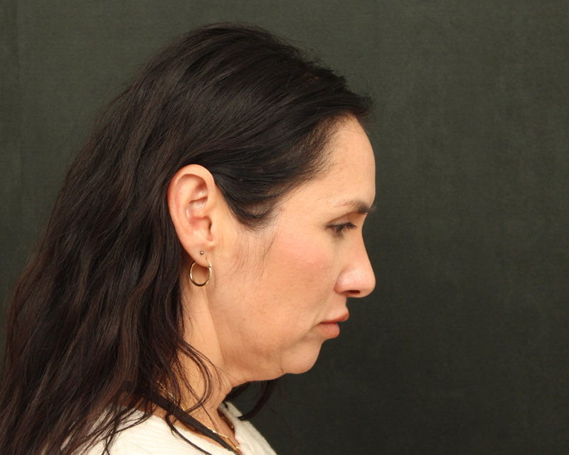 Neck Lift (Holiday Neck Lift™) Before & After Image