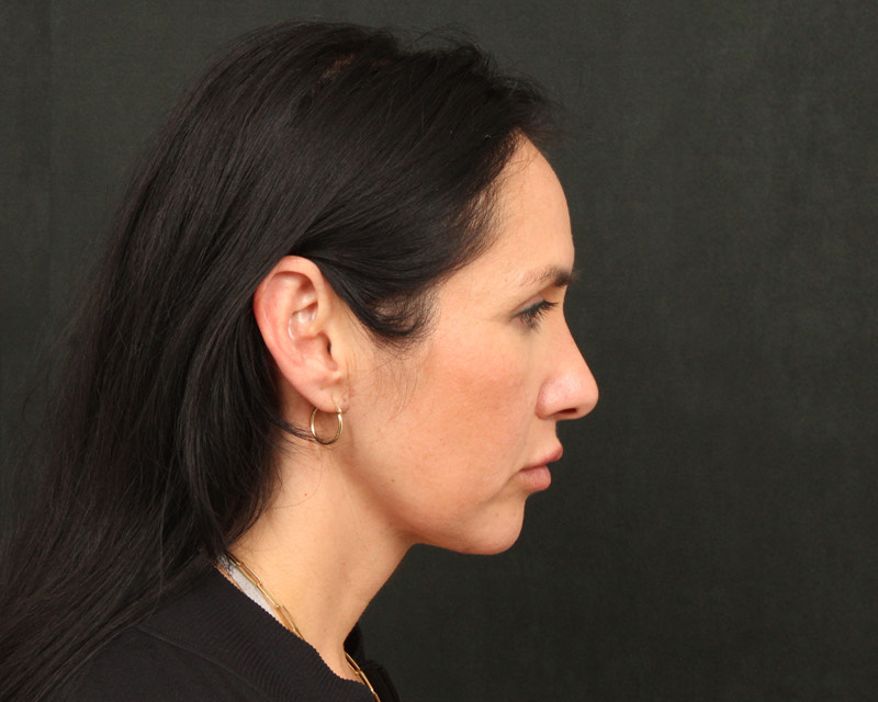 Neck Lift (Holiday Neck Lift™) Before & After Image