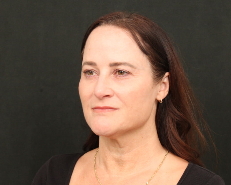 Neck Lift (Holiday Neck Lift™) Before & After Image