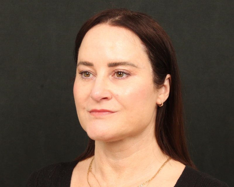 Neck Lift (Holiday Neck Lift™) Before & After Image