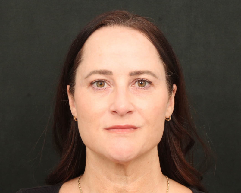 Neck Lift (Holiday Neck Lift™) Before & After Image