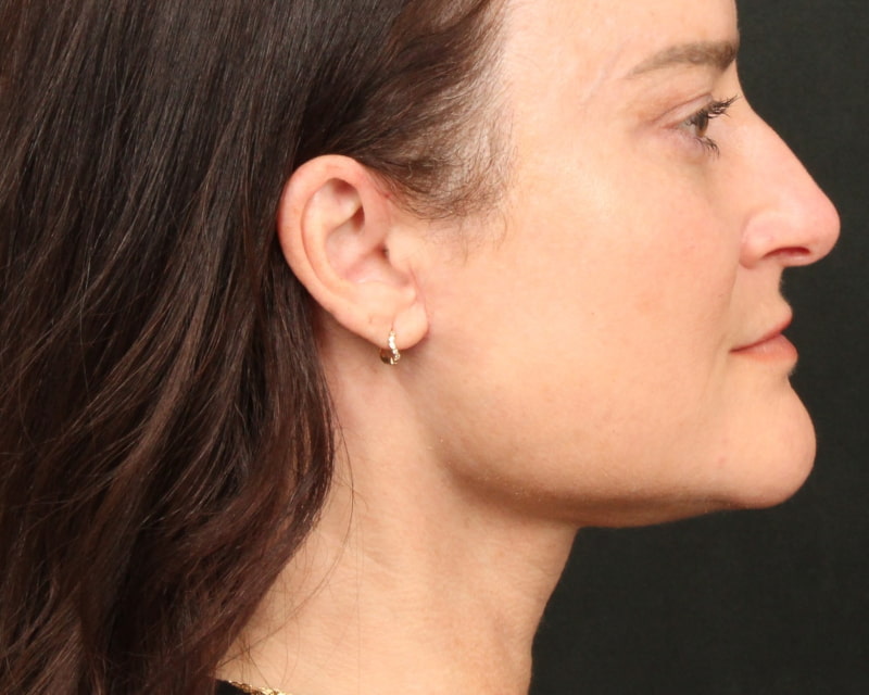 Neck Lift (Holiday Neck Lift™) Before & After Image