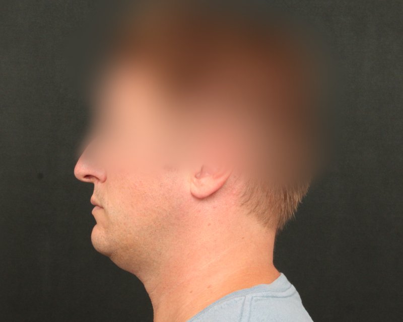 Neck Lift (Holiday Neck Lift™) Before & After Image