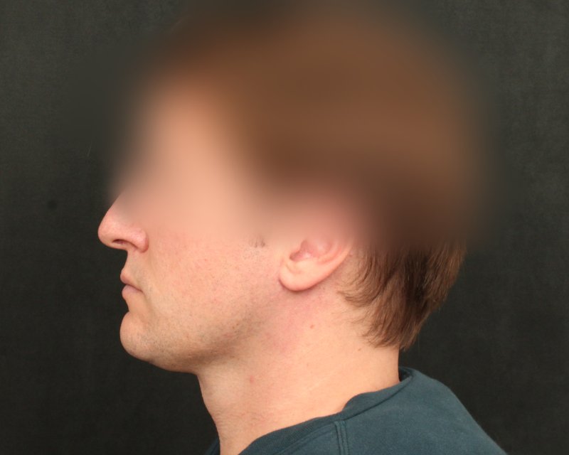 Neck Lift (Holiday Neck Lift™) Before & After Image