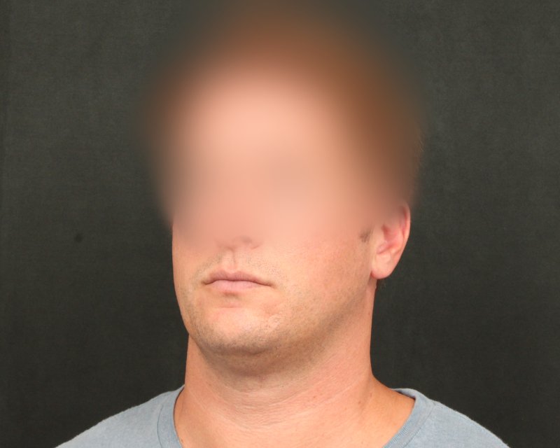 Neck Lift (Holiday Neck Lift™) Before & After Image