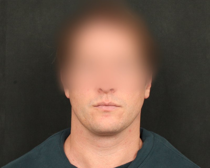 Neck Lift (Holiday Neck Lift™) Before & After Image