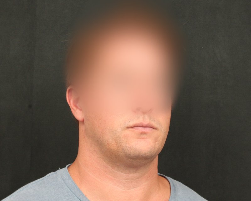 Neck Lift (Holiday Neck Lift™) Before & After Image