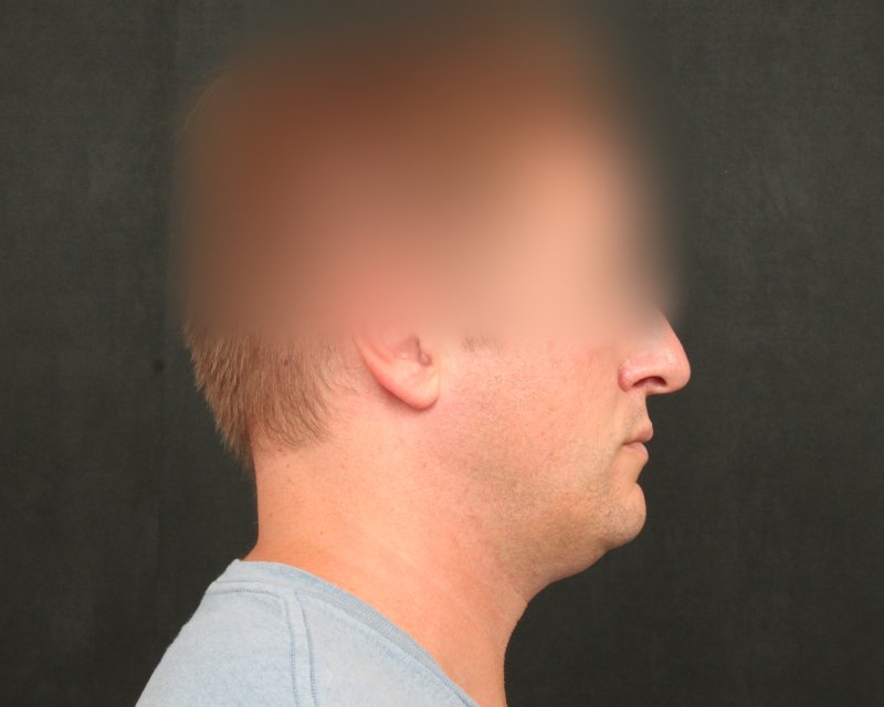 Neck Lift (Holiday Neck Lift™) Before & After Image