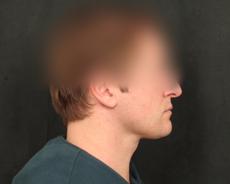 Neck Lift (Holiday Neck Lift™) Before & After Image