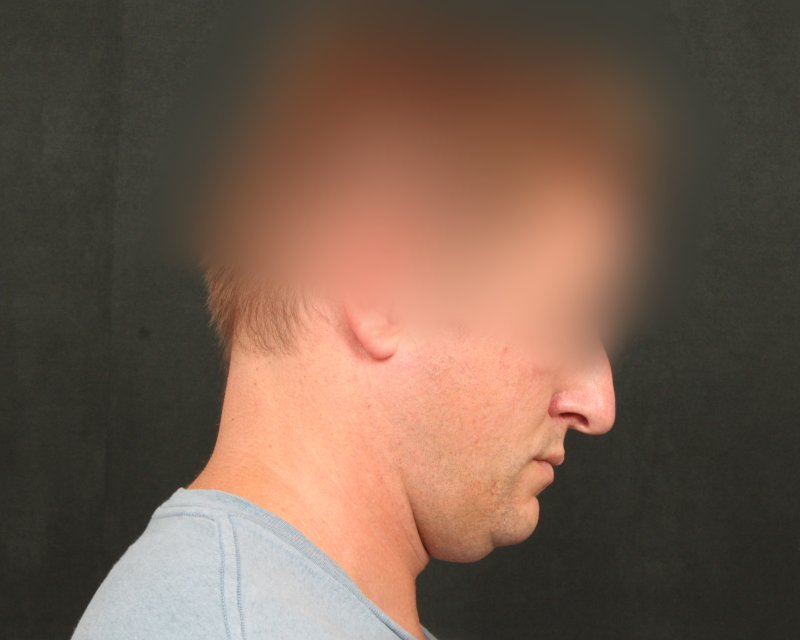 Neck Lift (Holiday Neck Lift™) Before & After Image