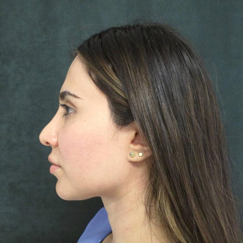 Revision Rhinoplasty Before & After Image