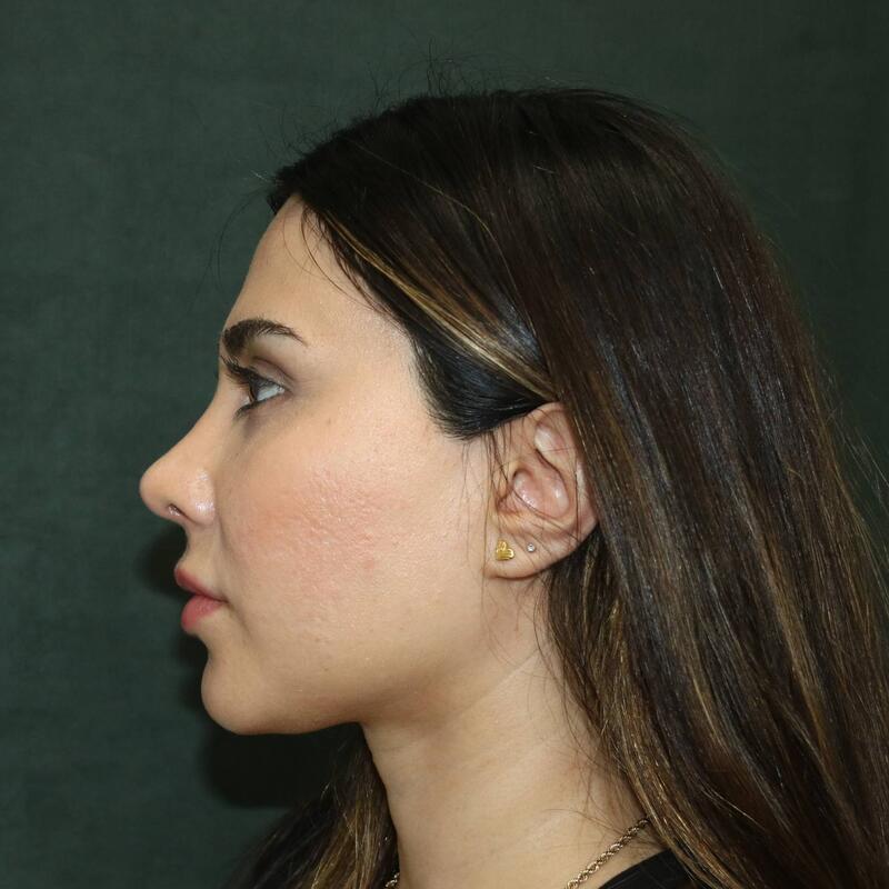 Revision Rhinoplasty Before & After Image