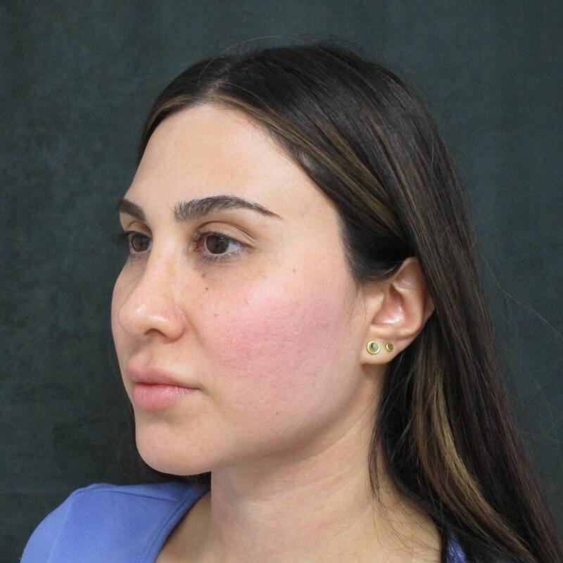 Revision Rhinoplasty Before & After Image