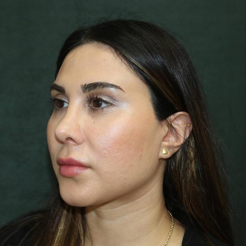 Revision Rhinoplasty Before & After Image