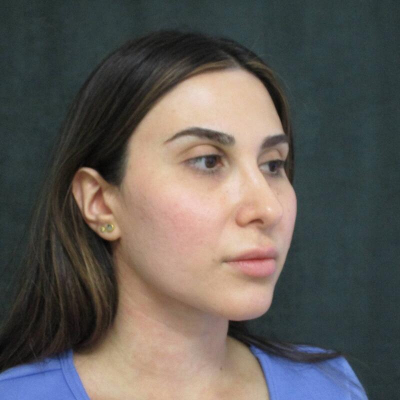 Revision Rhinoplasty Before & After Image