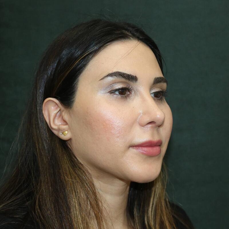 Revision Rhinoplasty Before & After Image