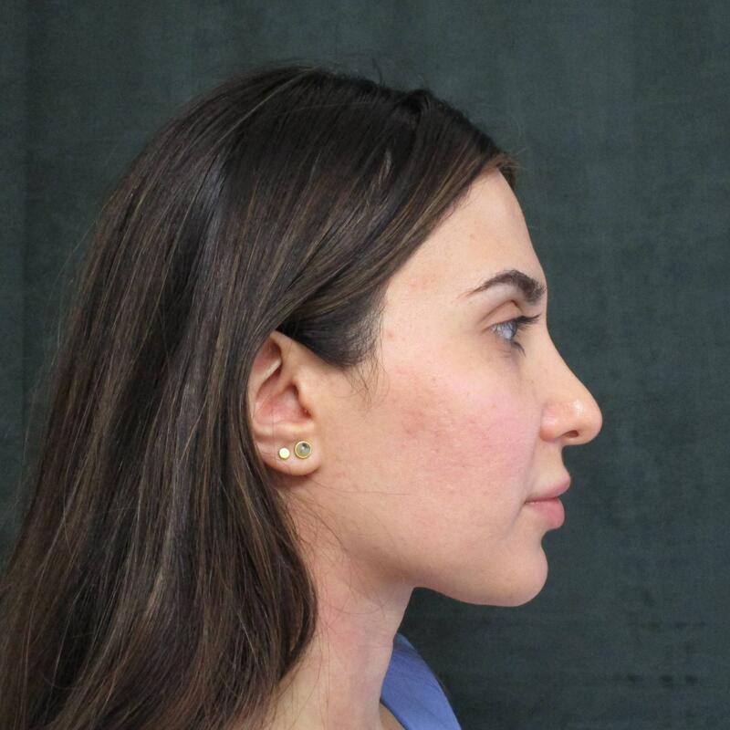 Revision Rhinoplasty Before & After Image