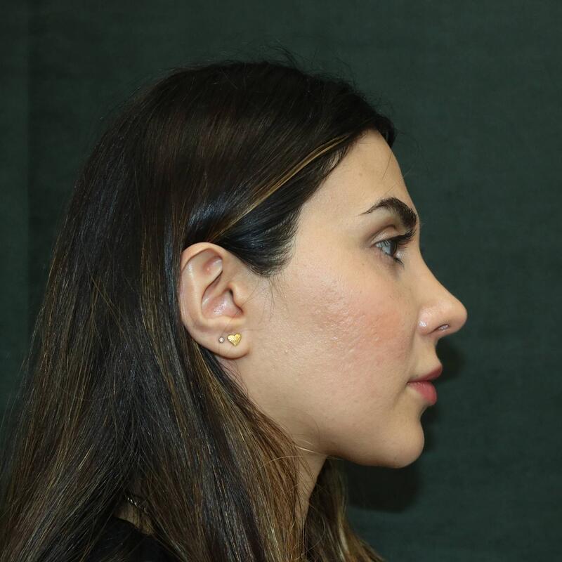 Revision Rhinoplasty Before & After Image