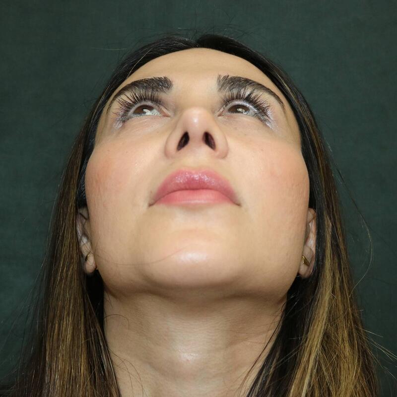 Revision Rhinoplasty Before & After Image