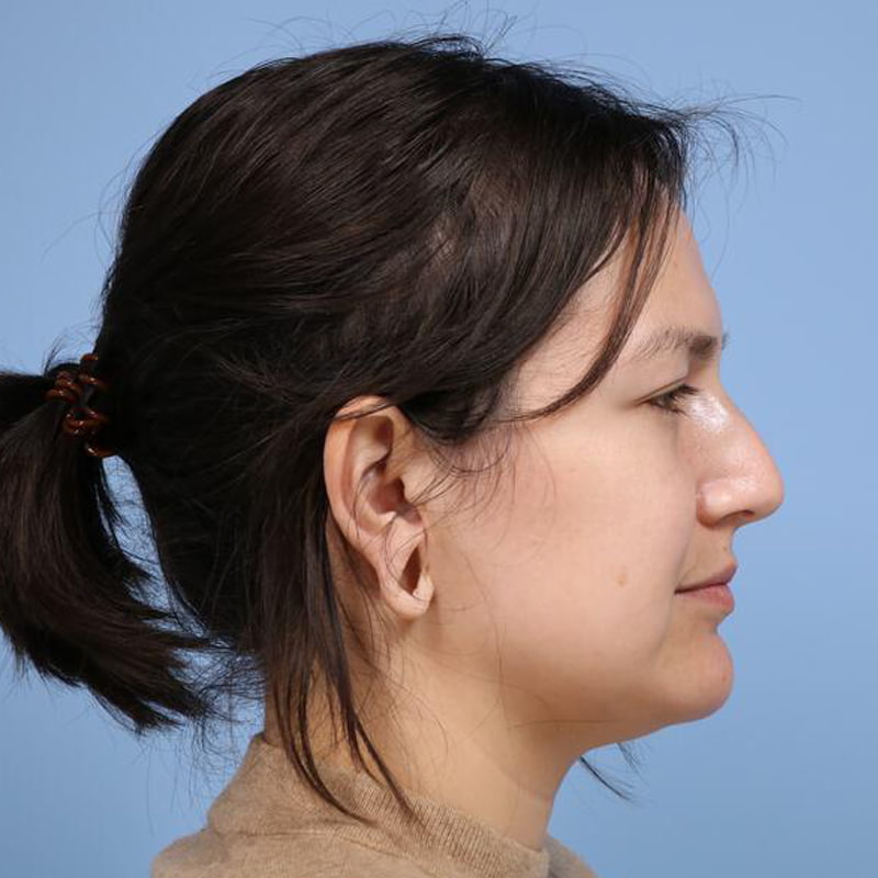 Rhinoplasty Before & After Image