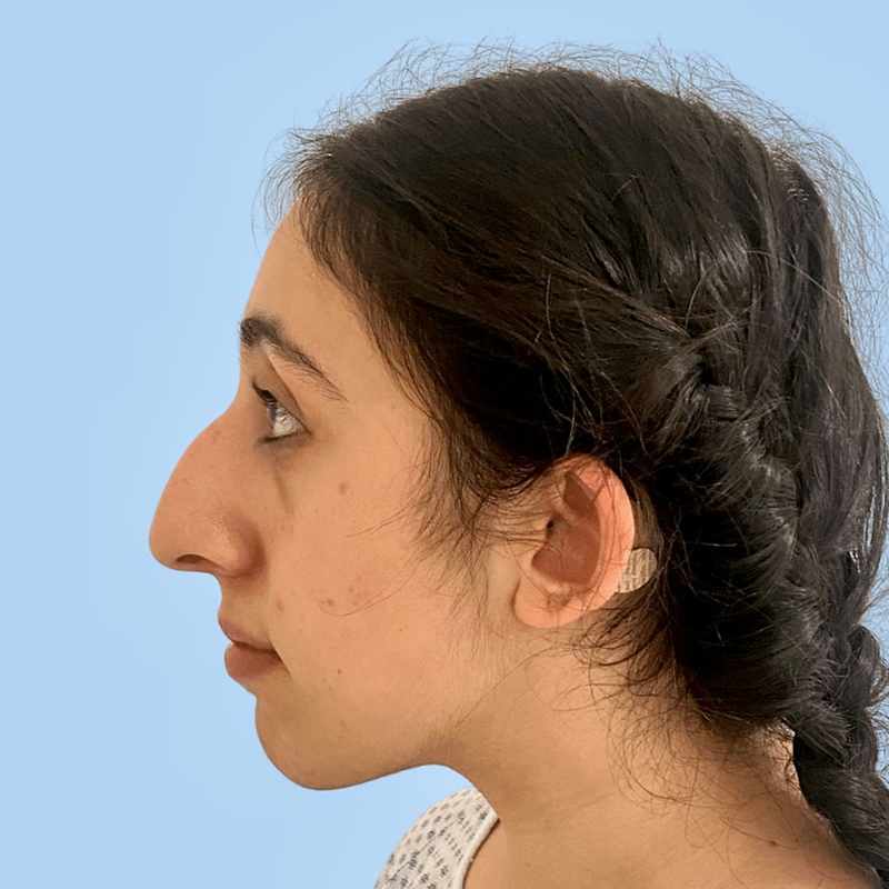 Rhinoplasty Before & After Image