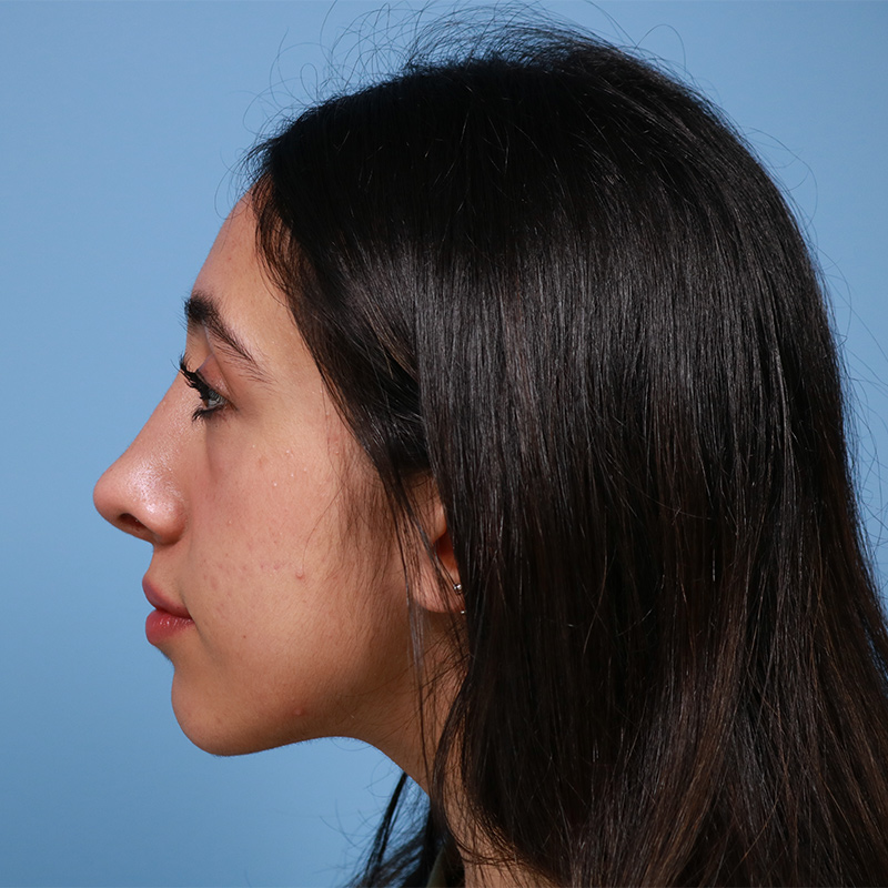 Rhinoplasty Before & After Image