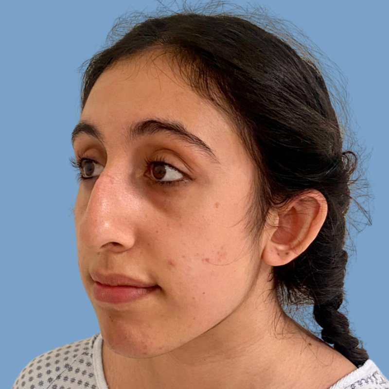 Rhinoplasty Before & After Image