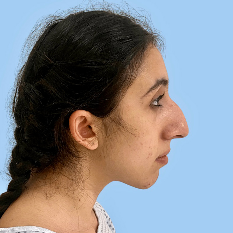 Rhinoplasty Before & After Image