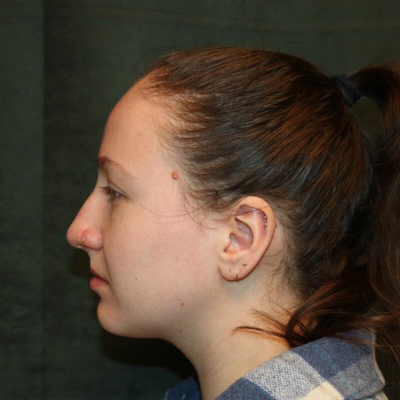 Rhinoplasty Before & After Image