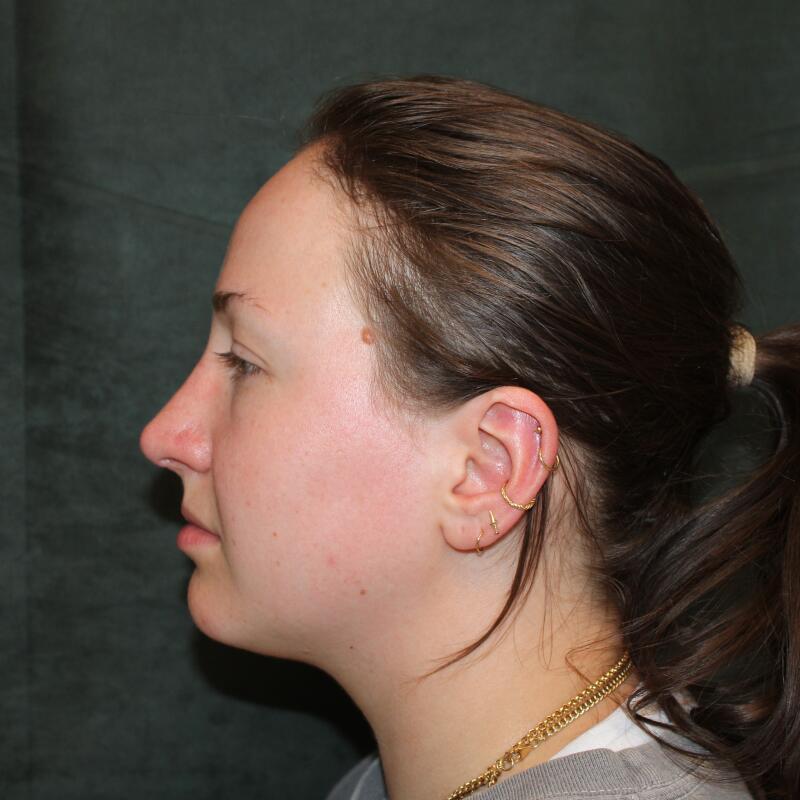 Rhinoplasty Before & After Image