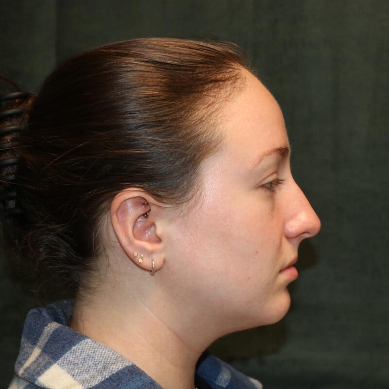 Rhinoplasty Before & After Image